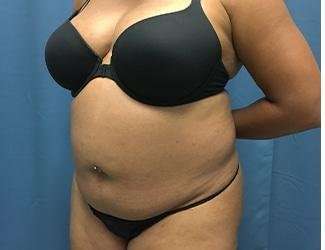 Tummy Tuck Before & After Patient #468
