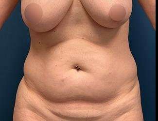 Tummy Tuck Before & After Patient #475