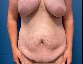 Tummy Tuck Before & After Patient #482