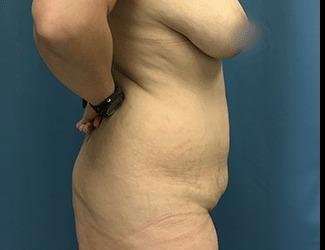 Tummy Tuck Before & After Patient #493
