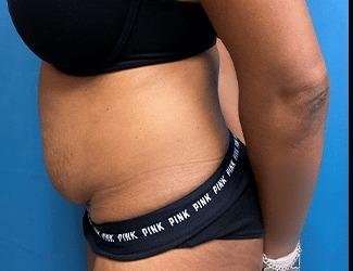 Tummy Tuck Before & After Patient #504