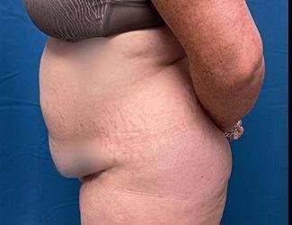 Tummy Tuck Before & After Patient #515
