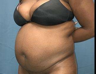 Tummy Tuck Before & After Patient #528