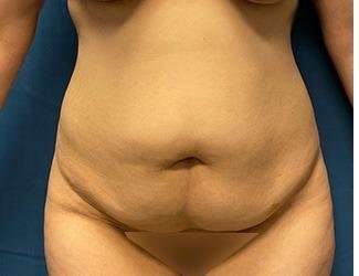 Tummy Tuck Before & After Patient #535
