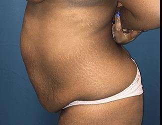 Tummy Tuck Before & After Patient #546