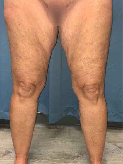 Thigh Lift Before & After Patient #553