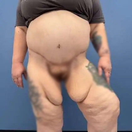 Massive Weight Loss Before & After Patient #995