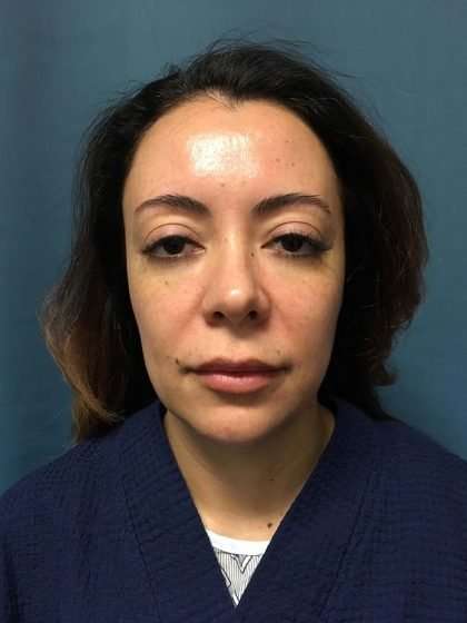 Submentoplasty Before & After Patient #586