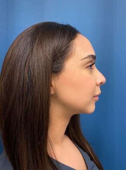 Submentoplasty Before & After Patient #597