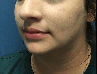 Submentoplasty Before & After Patient #610