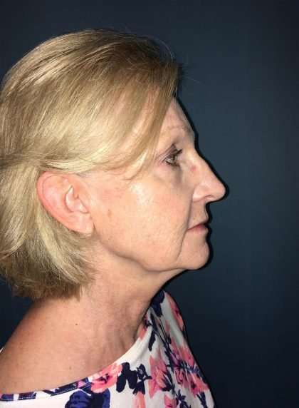Submentoplasty Before & After Patient #654