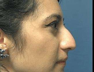 Rhinoplasty Before & After Patient #667