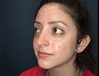 Rhinoplasty Before & After Patient #680