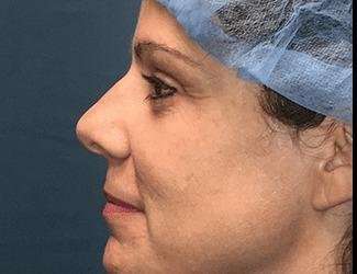 Rhinoplasty Before & After Patient #693