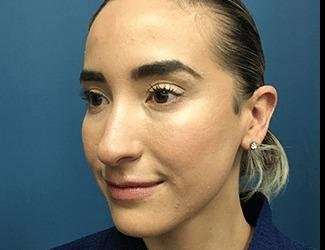 Rhinoplasty Before & After Patient #706