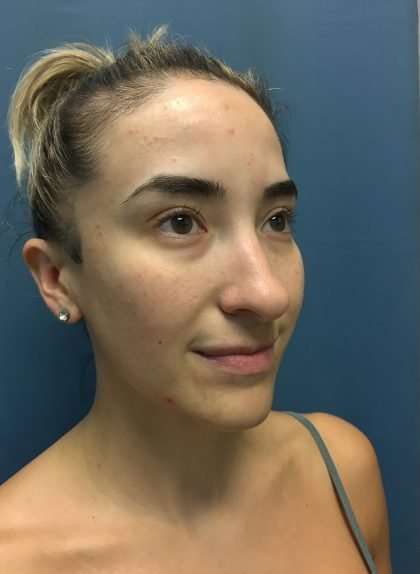 Rhinoplasty Before & After Patient #715
