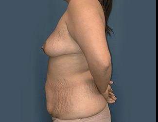 Mommy Makeover Before & After Patient #743