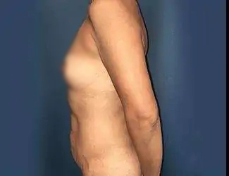 Mommy Makeover Before & After Patient #831