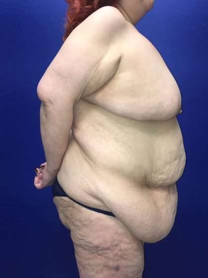 Mommy Makeover Before & After Patient #893