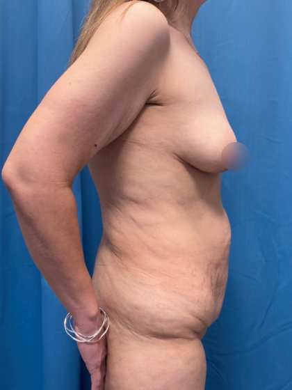 Mommy Makeover Before & After Patient #933