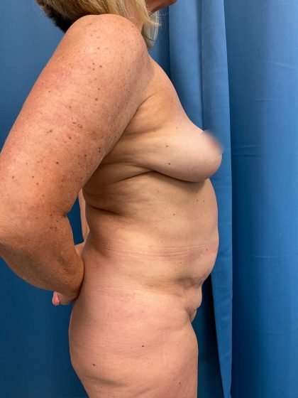 Tummy Tuck Before & After Patient #311