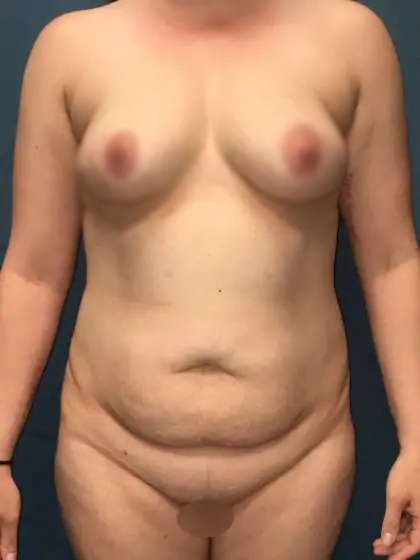Mommy Makeover Before & After Patient #951
