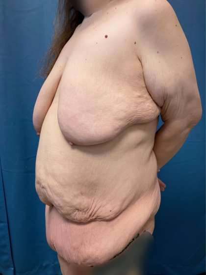 Massive Weight Loss Before & After Patient #986