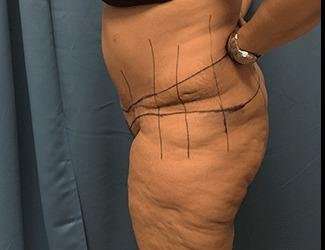 Lower Body Lift Before & After Patient #1047