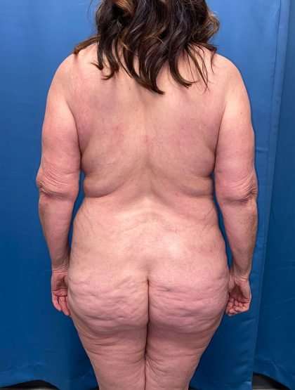 Lower Body Lift Before & After Patient #1063