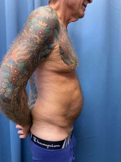Tummy Tuck Before & After Patient #322