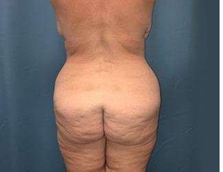 Lower Body Lift Before & After Patient #1101