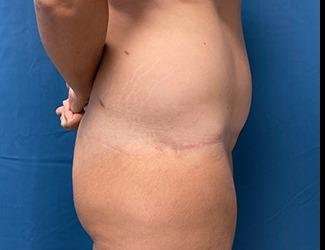 Lower Body Lift Before & After Patient #1127