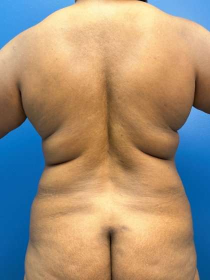 Lower Body Lift Before & After Patient #1154