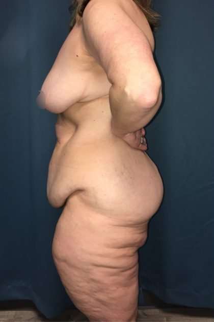Lower Body Lift Before & After Patient #1174