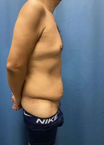 Tummy Tuck Before & After Patient #333