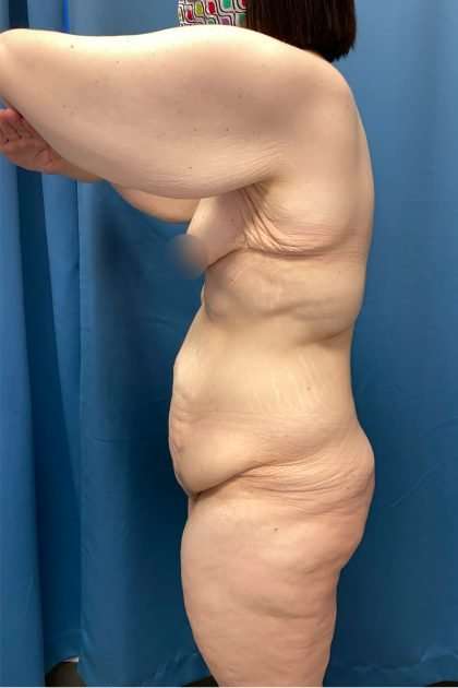 Lower Body Lift Before & After Patient #1187