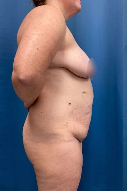 Lower Body Lift Before & After Patient #1200