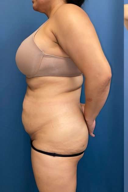 Lower Body Lift Before & After Patient #1213