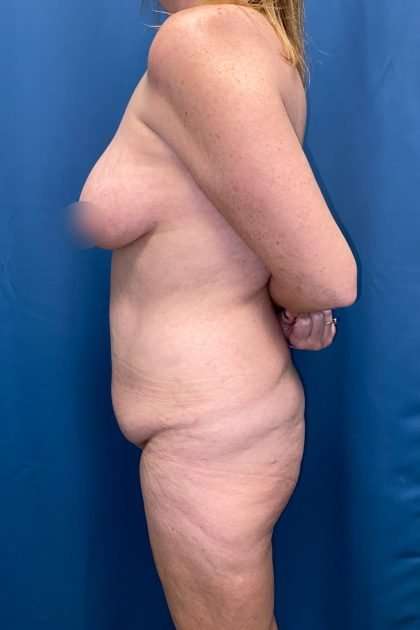 Lower Body Lift Before & After Patient #1239