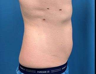 Liposuction Before & After Patient #1257