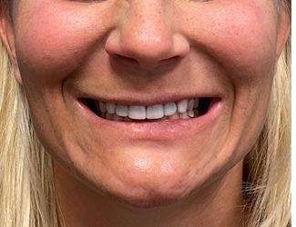 Lip Lift Before & After Patient #1289