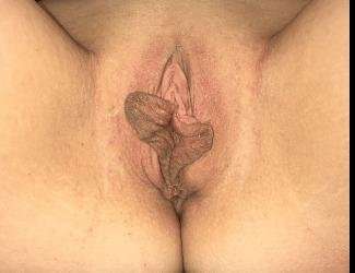Labiaplasty Before & After Patient #1340