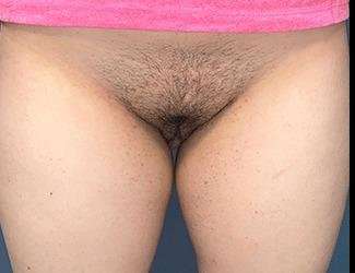 Labiaplasty Before & After Patient #2772