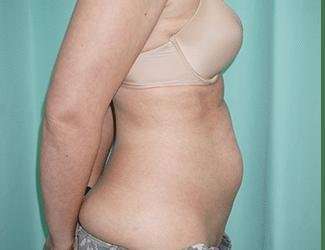 Tummy Tuck Before & After Patient #340