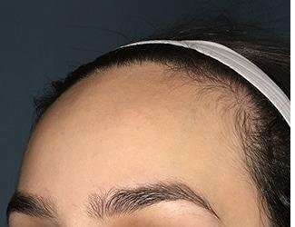 Forehead Reduction Before & After Patient #1364