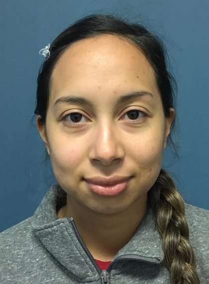 Forehead Reduction Before & After Patient #1371