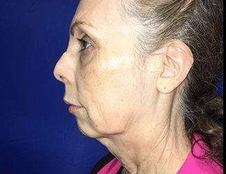 Facial Implants Before & After Patient #1392