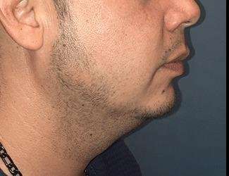 Facial Implants Before & After Patient #1403