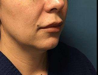 Facial Implants Before & After Patient #1464