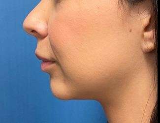 Facial Implants Before & After Patient #1475
